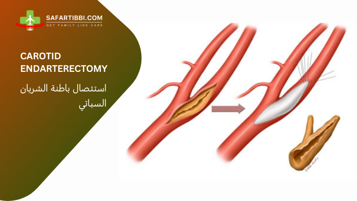 Carotid Endarterectomy: A Guide To Vascular Health - Safartibbi